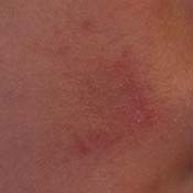 Worrybomb has a Stork Mark