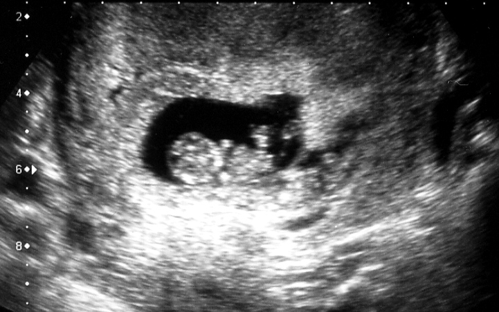 The first and dating scan