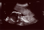 20 week scan of the Worrybomb